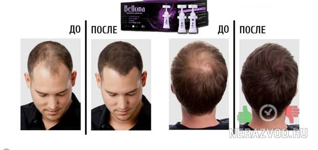 выпадение волос