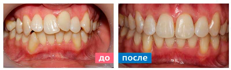 До и после использования G-Tooth Trainer