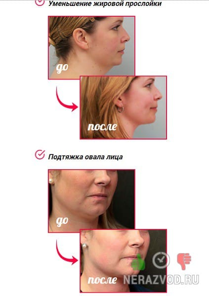 миостимулятор Face Shaper