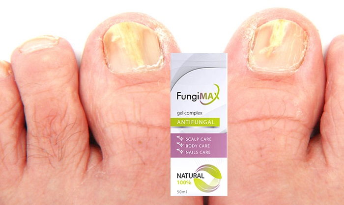 Fungimax от грибка стопы и ног: быстро устранит неприятный запах и зуд!