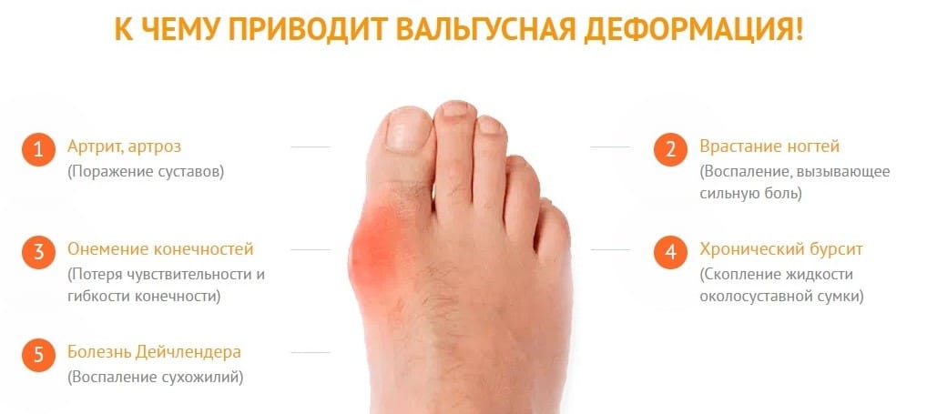 Чем опасна вальгусная деформация стопы?