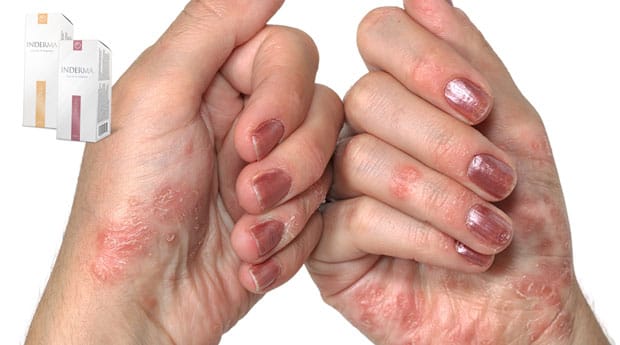 inderma от псориаза купить