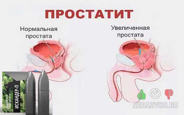 хронический простатит