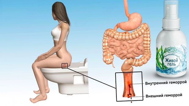 Чем лечить внутри. Внутренний и внешний геморрой.
