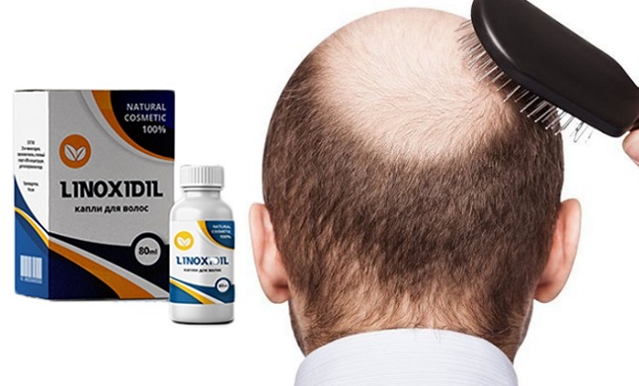 Linoxidil для волос: возвращает вашим локонам блеск, красоту и здоровье!