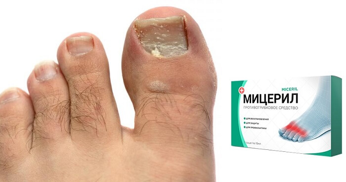 Мицерил против грибка и вросшего ногтя: сохраните здоровье и красоту ног!