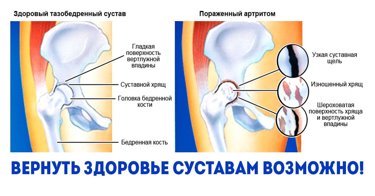 Суставы детей. Ревматоидный артрит тазобедренного сустава. Артрит тазобедренного сустава у ребенка. Артрит тазобедренного сустава. Артрит бедренного сустава.