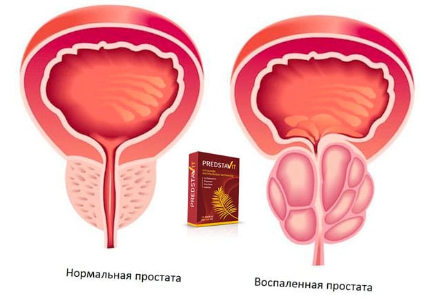 Predstavit препарат от простатита купить