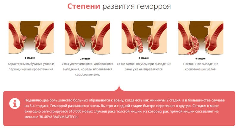 Лечение геморроя в домашних условиях. Как и чем лечить?