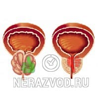 капсулы Простатонис