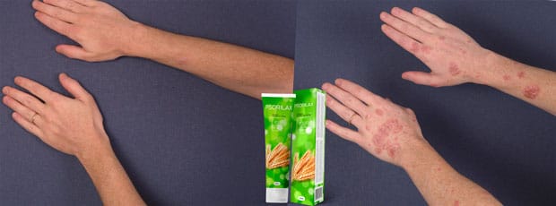 psorilax купить