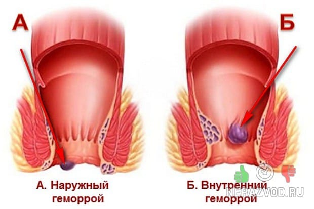 варикозное расширение сосудов