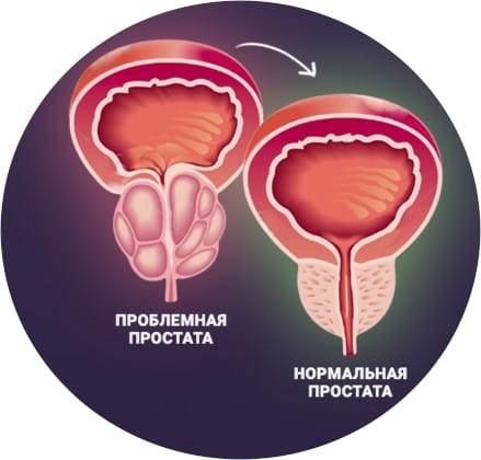 Лечение простатита в Казани — острого, хронического, бактериального