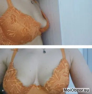 Грудь до и после