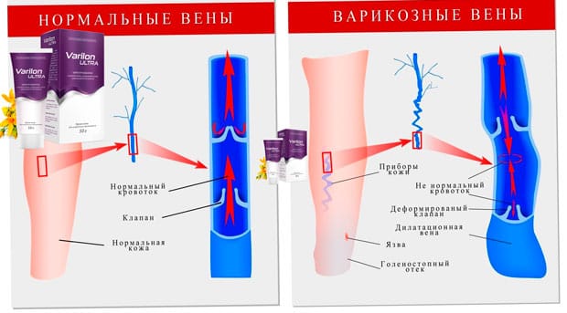причины варикоза