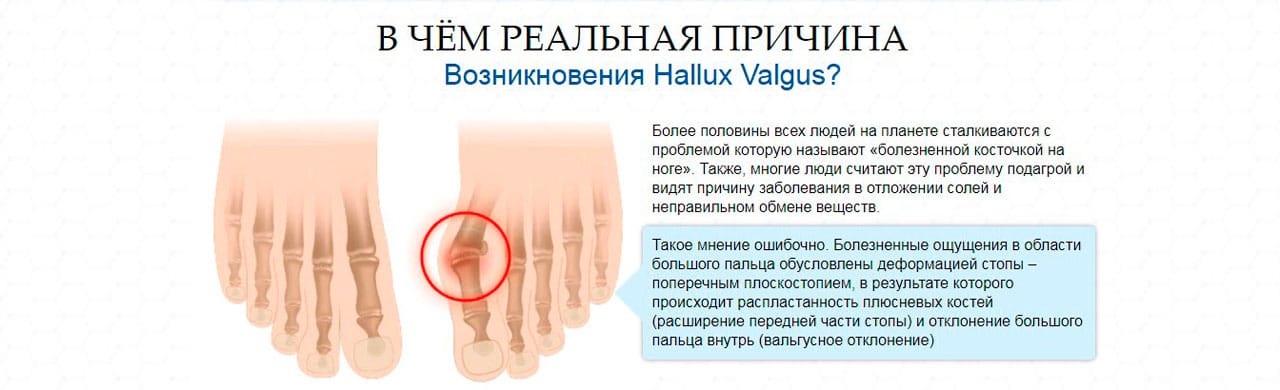 Почему перестала расти нога. Причина халлюкс вальгус. Вальгусная деформация пальца стопы. Деформация большого пальца ноги.