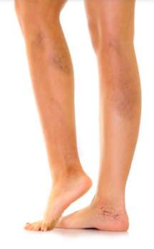 Ноги до применения крема Варикозон от варикоза