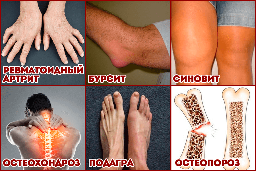 Заболевания опорно-двигательного аппарата Заболевания опорно-двигательного аппарата