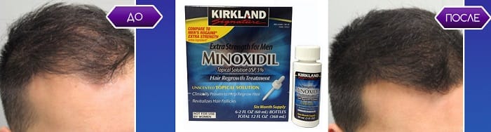 Se puede comprar minoxidil sin receta